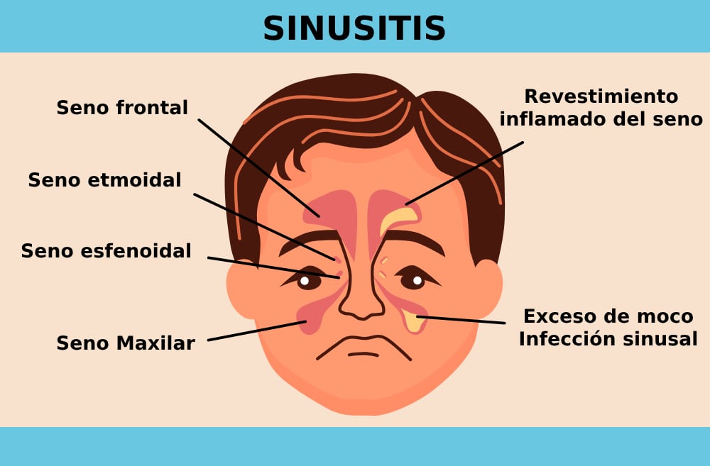 qué es sinusitis