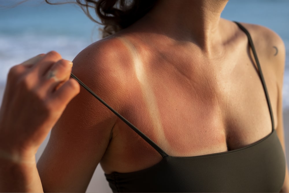 tipos de quemaduras solares