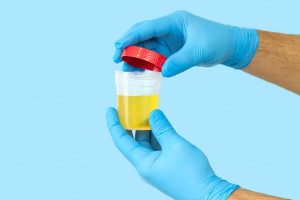 Manos con guantes cerrando un recipiente estéril con muestra de orina